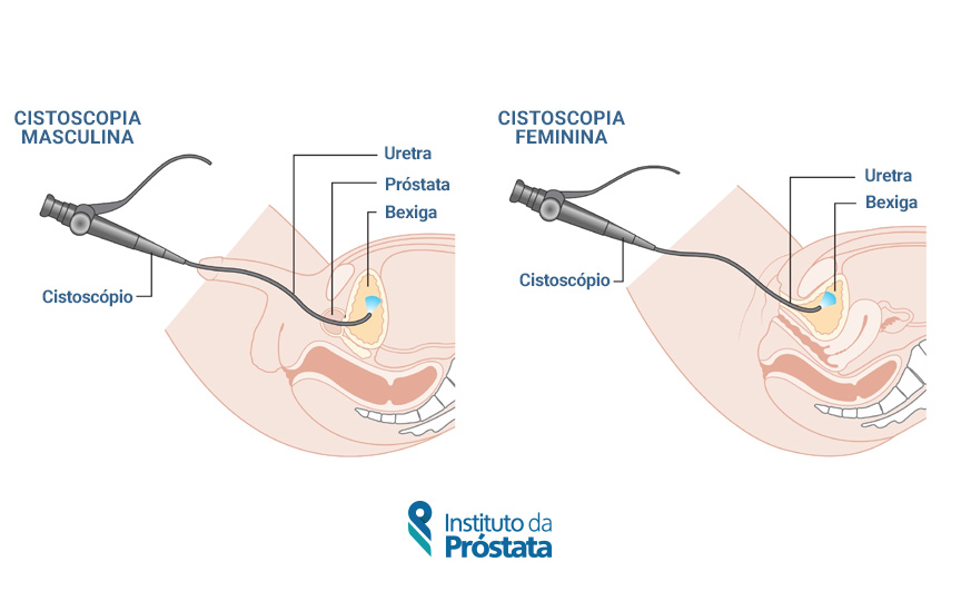02 Cistoscopia Instituto Da Prostata Info