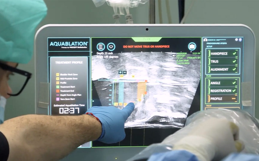 Aquablacao Para Hbp Como Funciona Instituto Da Prostata