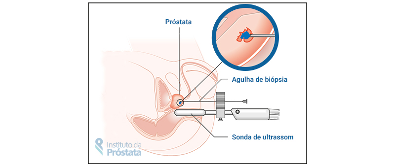 Biopsia Prostata De Fusao