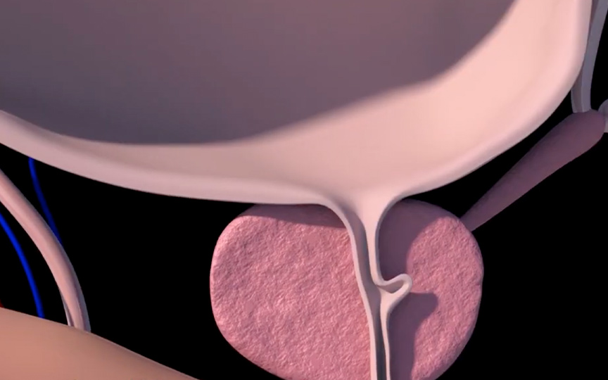 Hiperplasia Benigna Da Prostata Sintomas Instituto Da Prostata