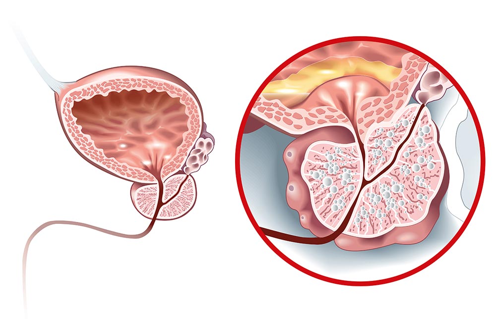 remedii pentru durerea de rinichi hiperplasia benigna de próstata: tratamientos