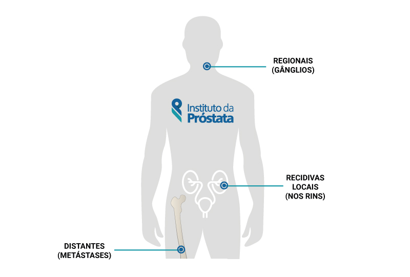 probabilidad de recidiva cáncer de próstata